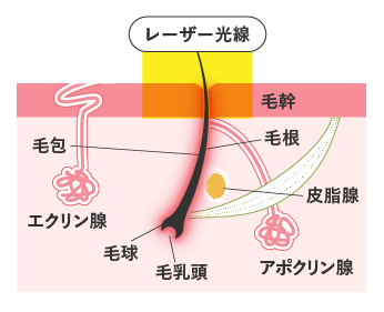 医療脱毛のイメージ