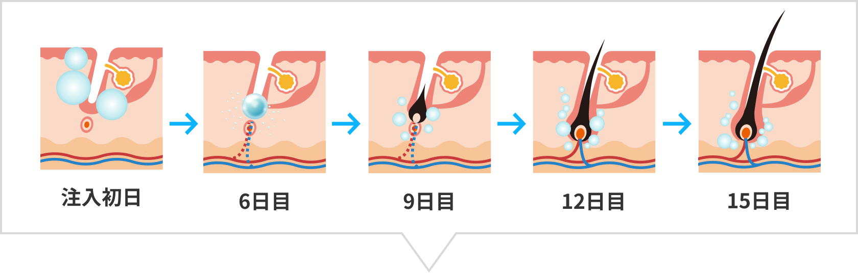 DR.CYJヘアフィラーのメカニズム