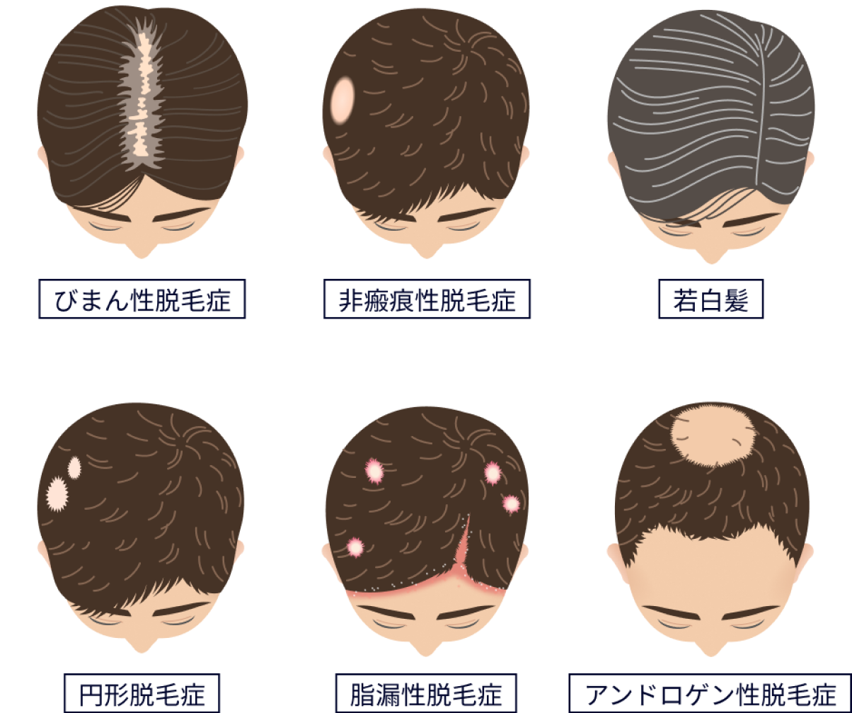 DR. CYJヘアフィラーの適用例