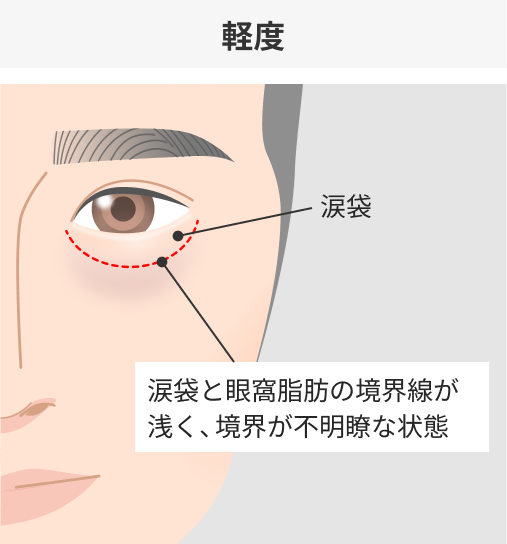 軽度