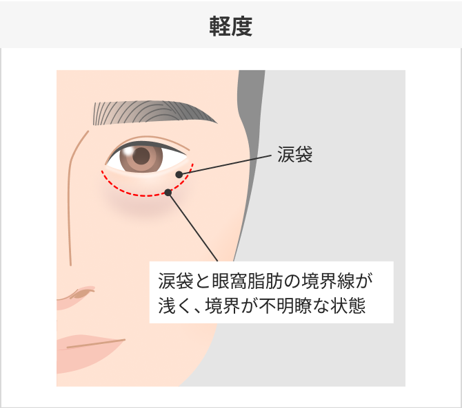 軽度