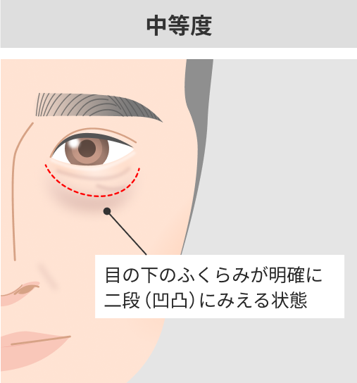 中度
