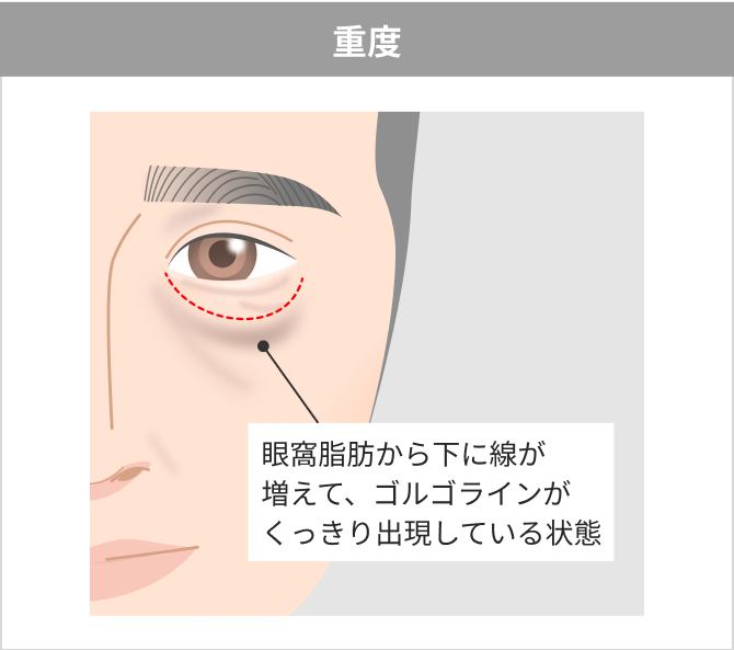 重度