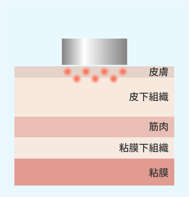 ミラーピール施術イメージ