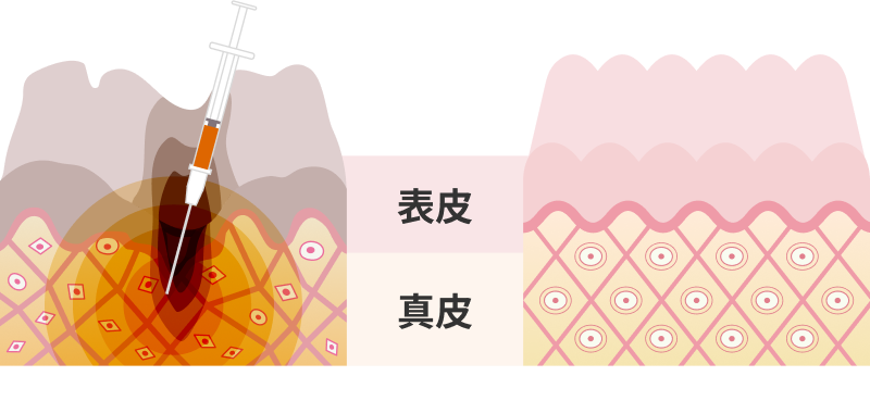 表皮・真皮
